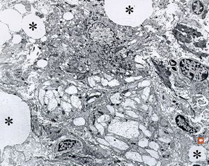 Whipple disease Whipple disease